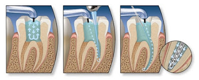 Quy trình lấy tủy răng tại nha khoa