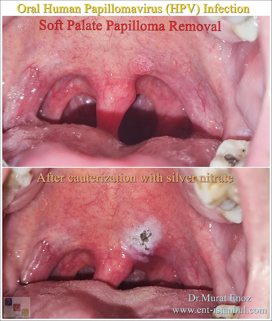 HPV treatment in the mouth,AHCC,squamous papilloma,HPV wart in the mouth,oral papilloma,HPV,