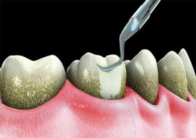 Bác sĩ cho hay vôi răng có gây hôi miệng không-1