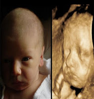 3d Ultrasound Pictures Pregnancy1