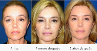 Rejuvenecimiento facial regenerativo