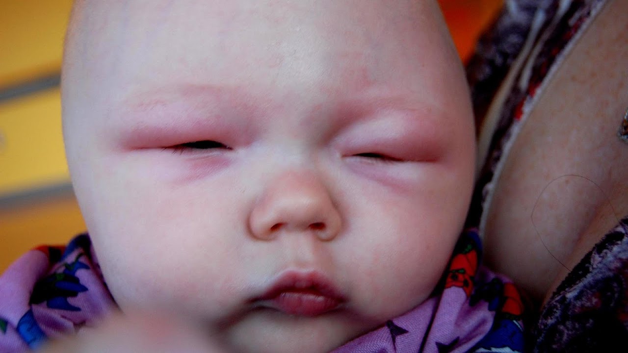 Allergy Swollen Eyes