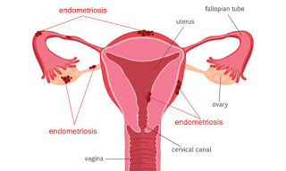 Endometriosis:A disease that takes over seven years to be diagnosed.