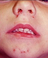 Impetigo  CAUSE SYMPTOMS TREATMENT