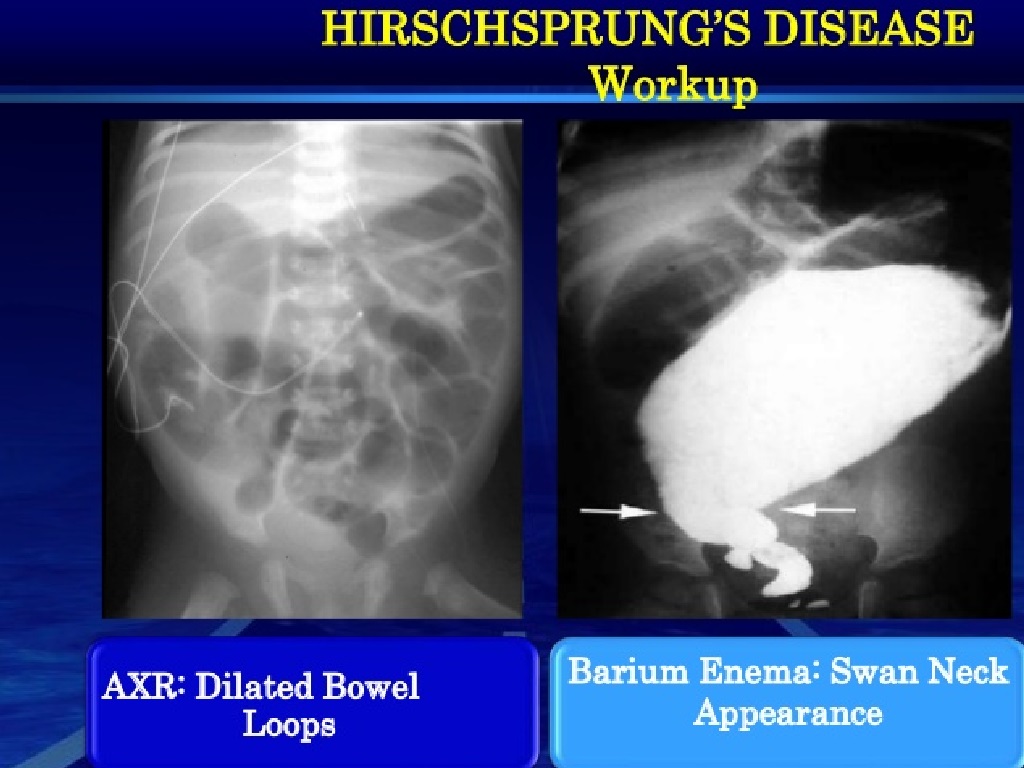 Penyakit Hirschsprung Penyumbatan Usus Besar 