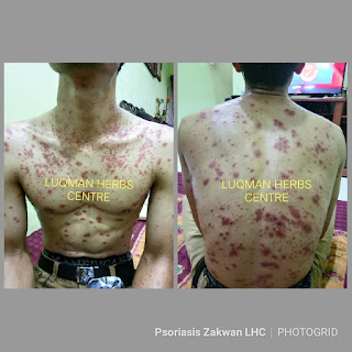 Rawat Sakit Kulit Psoriasis dan Sakit Kulit lain dengan 