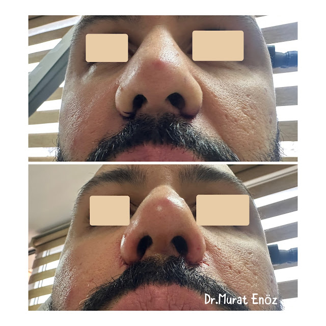 Nostril Reduction Surgery in Istanbul,Alar Base Resection,  Wide flaring nostrils