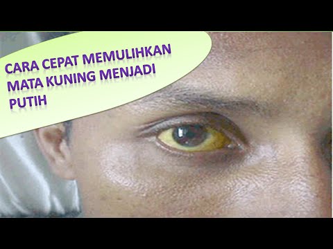 Cara Tradisional Pulihkan Mata Kuning Jadi Putih Kembali