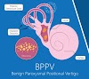 What is BPPV & How do you treat it?