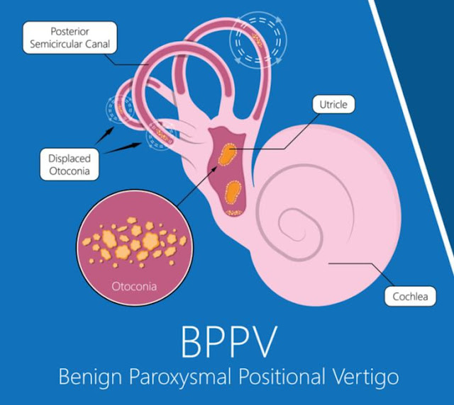 What is BPPV