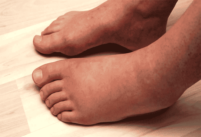 Leg Swelling: Causes and Dangers, Kochi, News, Leg Swelling, Health Tips, Health, Doctors, Warning, Symptoms, Kerala News