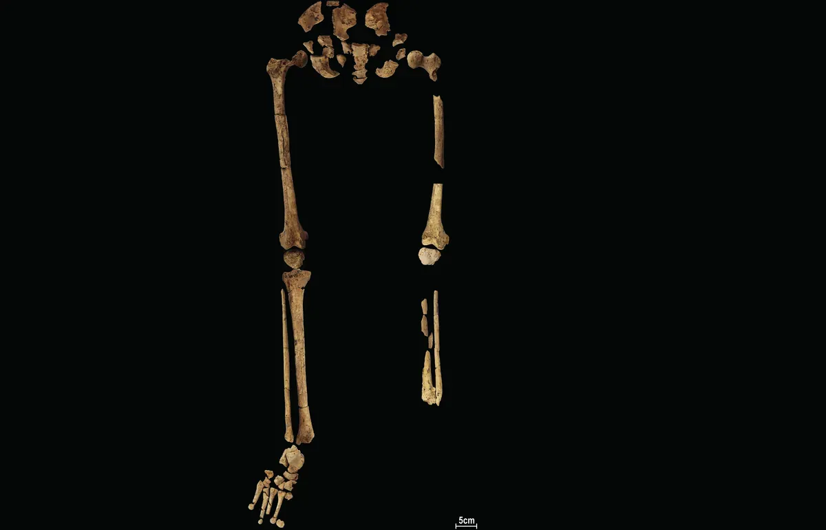 O registro de amputação médica mais antiga do mundo tem 31.000 anos1