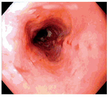 Labels: Acid Reflux Images , GERD diagnosis , REFLUX ESOPHAGITIS 