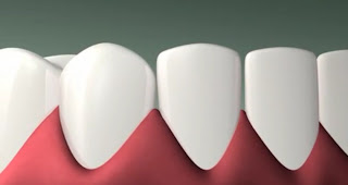 протезирование зубов имплантация зубов