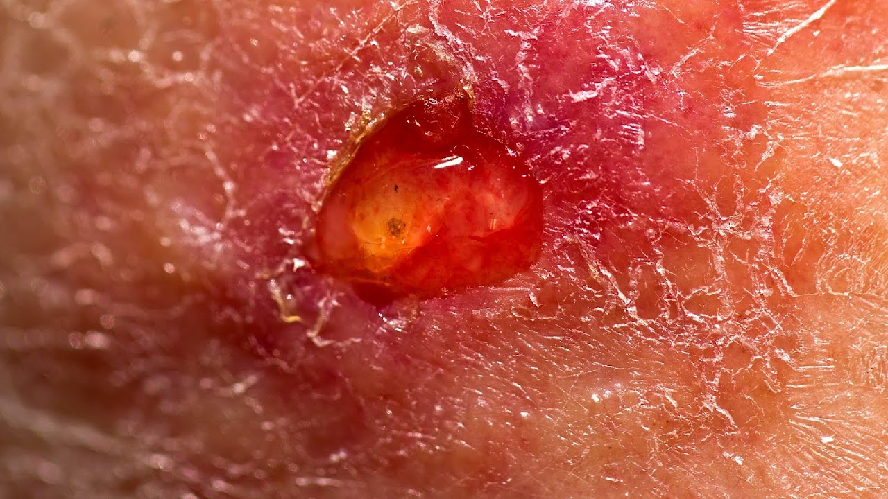 Ulcers On The Skin