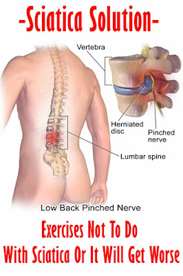 Sciatica