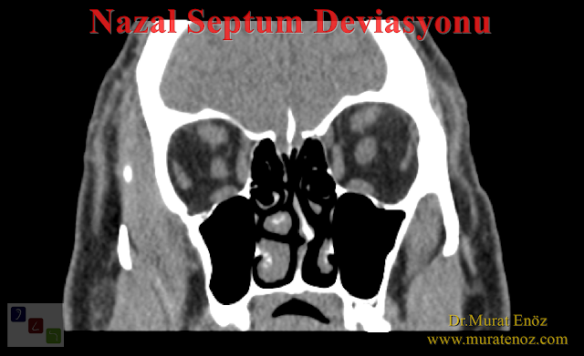 Nazal septum deviasyonu nasıl anlaşılır? - Septum deviasyonu belirtileri - Burunda kıkırdak eğriliği belirtileri - Nazal septum eğriliği belirtileri - Burunda kemik eğriliği belirtileri - Nazal septum deviasyonu nasıl anlaşılır?