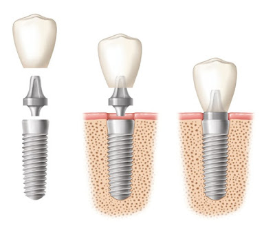 Phục hình răng đã mất bằng cấy ghép implant