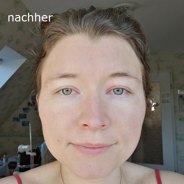 Haut nachher