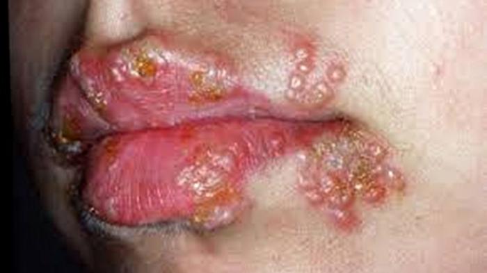 cara mengatasi herpes