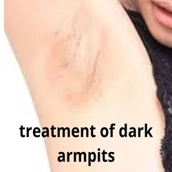 treatment of dark armpits. Dark armpits of a beautiful young lady