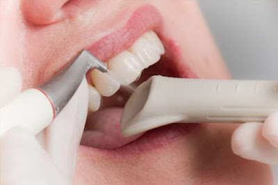 Cạo vôi răng không đúng cách có tác hại gì?