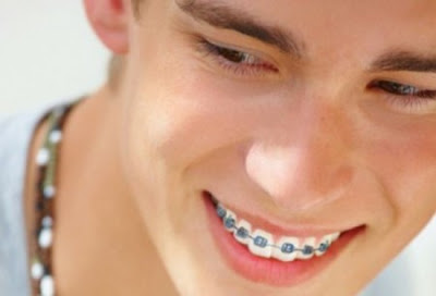 Quy trình niềng răng mặt trong chỉnh hô nên biết