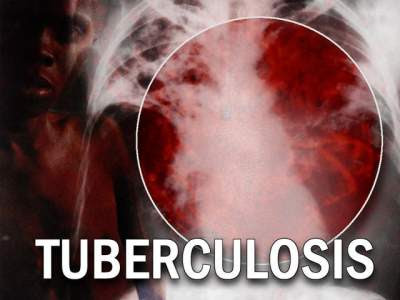 7 Fakta Penyakit Tuberkulosis Yang Perlu Anda Ketahui