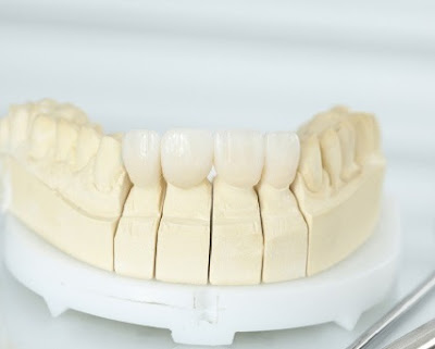 Làm sao để tránh bọc răng sứ bị cộm?