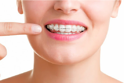 Phương pháp niềng răng khểnh với mắc cài sứ