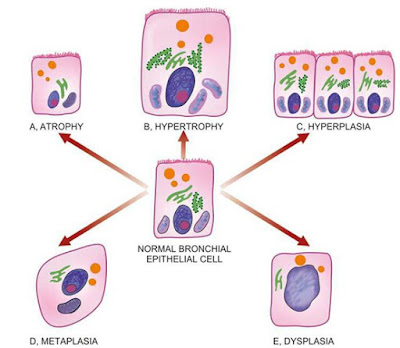 Atrophy, adaptive disorders, aasgaduli, pathology