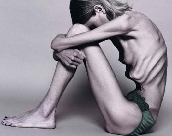 causas de la bulimia. CAUSAS DE LA ANOREXIA:
