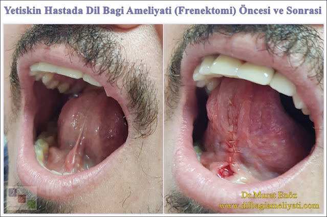 Erişkin Hastada Dil Bağı Operasyonu Öncesi ve Sonrası