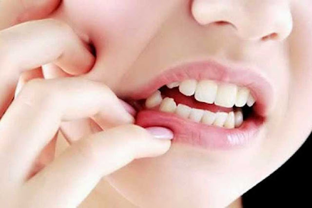 Cara Alami Mengobati Sakit Gigi Paling Ampuh