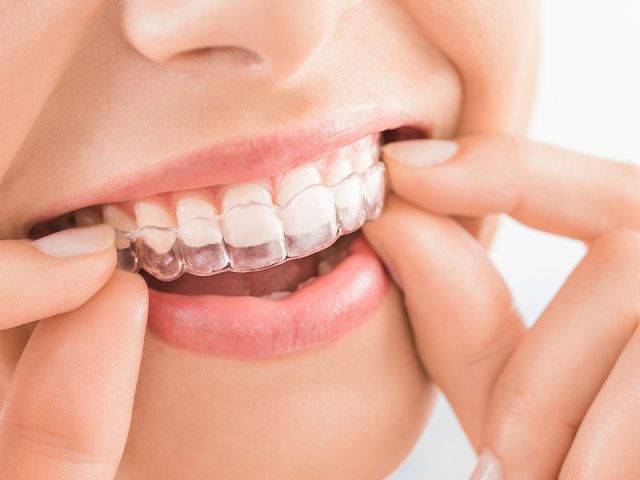 Maintenance and Care Costs for Invisalign Aligners: A Comprehensive Guide