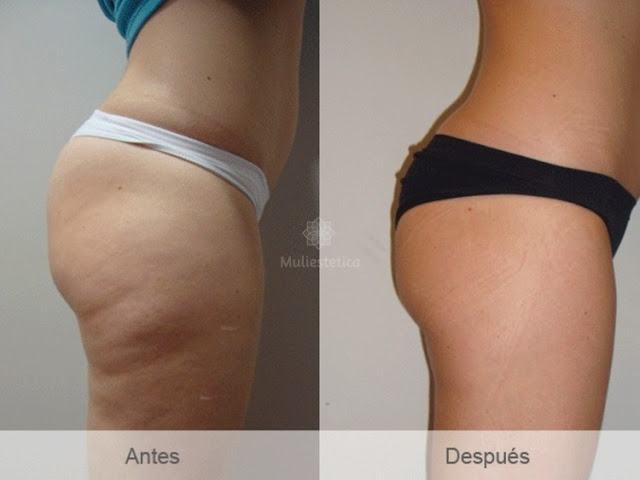 Mesoterapia grasa localizada