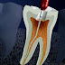  Bọc răng sứ có cần phải lấy tủy răng không?