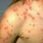 Symptoms And Treatment Of Smallpox