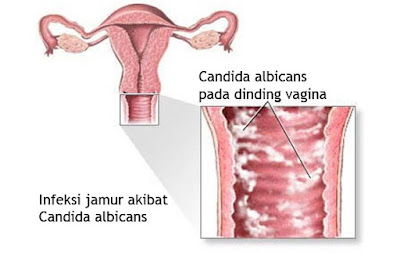 Cara Mengobati Keputihan Jamur Candida