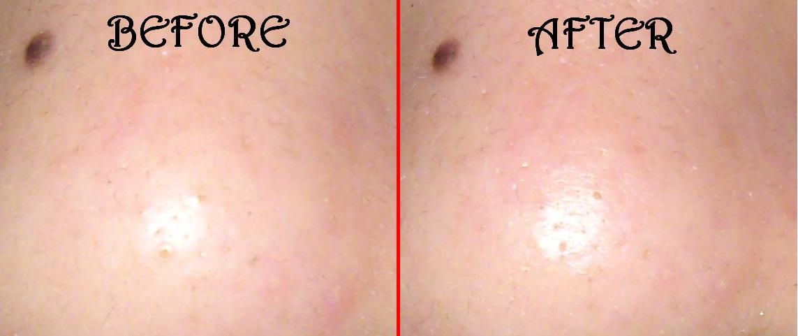 (before-and-after pic of my nose. Some clogged pores are visible on )