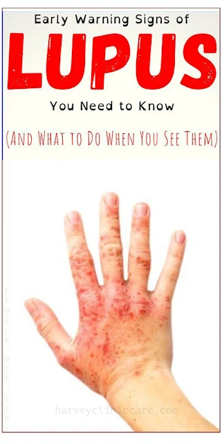 Early Warning Signs of Lupus You Need to Know (And What to Do When You See Them)