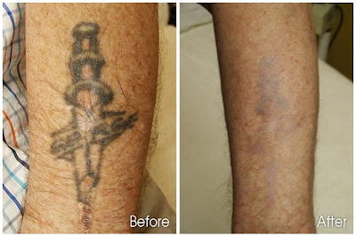 Laser Tattoo Removal