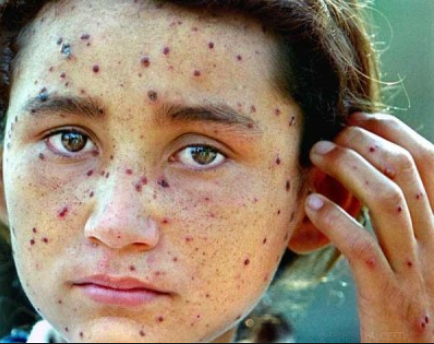 Cara Hilangkan Parut Chicken Pox Yang Buruk & Hodoh, Bagi Cara Hilangkan Parut Chicken Pox Yang Buruk & Hodoh, Bagi