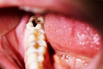 Đau răng hàm trong cùng có nên nhổ bỏ? 2