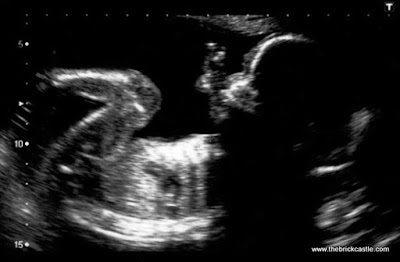 Scan photo showing baby sucking his thumb in the womb