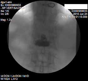 Images of a vertebroplasty (kyphoplasty).