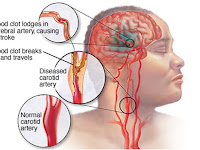 Mengobati Stroke Sendiri