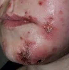 What is Staph Infections