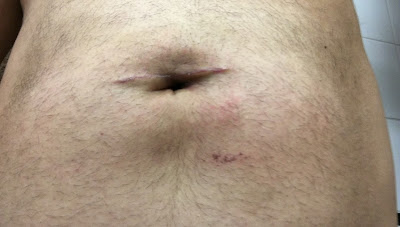 Three weeks after hernia repair at Shouldice  - front