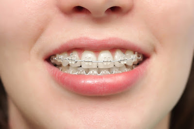 Phương pháp niềng răng người lớn